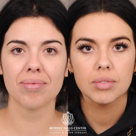 Beverly Hills Center Female Patient Before and After Brow Lift, Profound RF, Nanofat PRP