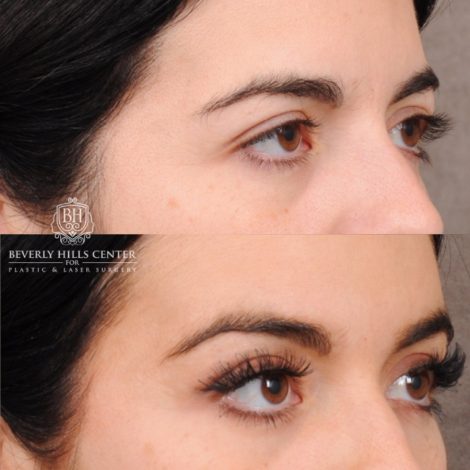 Beverly Hills Center Female Patient Before and After Brow Lift, Profound RF, Nanofat PRP