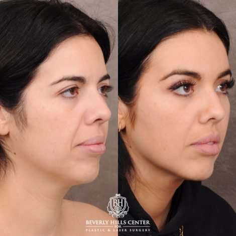 Beverly Hills Center Female Patient Before and After Brow Lift, Profound RF, Nanofat PRP