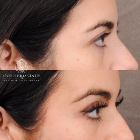 Beverly Hills Center Female Patient Before and After Brow Lift, Profound RF, Nanofat PRP