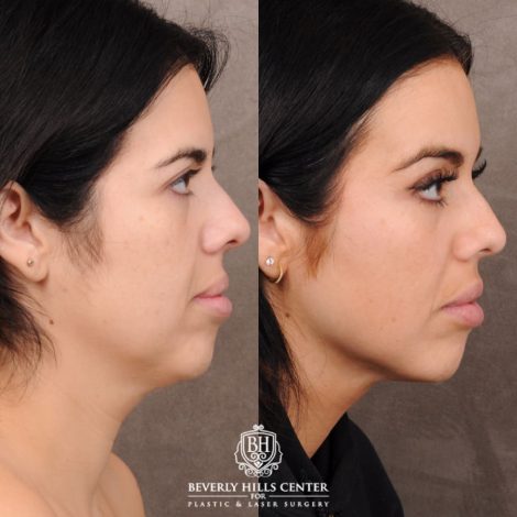 Beverly Hills Center Female Patient Before and After Brow Lift, Profound RF, Nanofat PRP