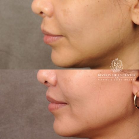 Beverly Hills Center Female Patient Before and After CUPID LIFT® Lip Lift Procedure