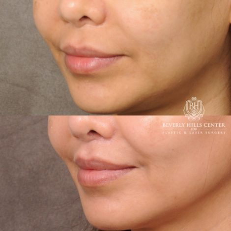 Beverly Hills Center Female Patient Before and After CUPID LIFT® Lip Lift Procedure