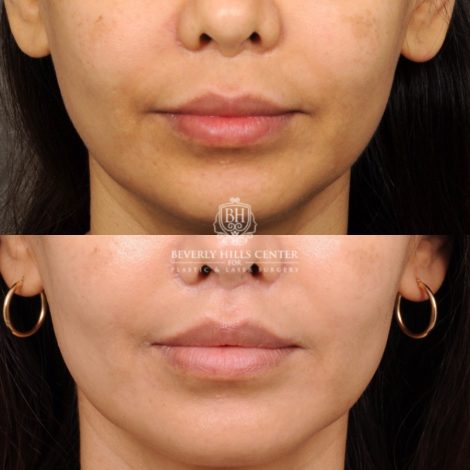 Beverly Hills Center Female Patient Before and After CUPID LIFT® Lip Lift Procedure