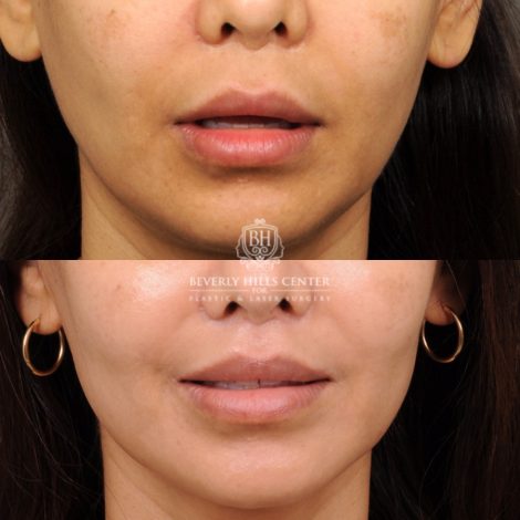 Beverly Hills Center Female Patient Before and After CUPID LIFT® Lip Lift Procedure