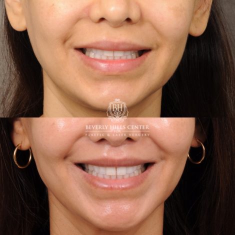 Beverly Hills Center Female Patient Before and After CUPID LIFT® Lip Lift Procedure