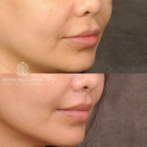 Beverly Hills Center Female Patient Before and After CUPID LIFT® Lip Lift Procedure