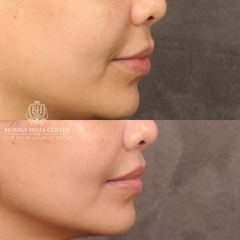 Beverly Hills Center Female Patient Before and After CUPID LIFT® Lip Lift Procedure