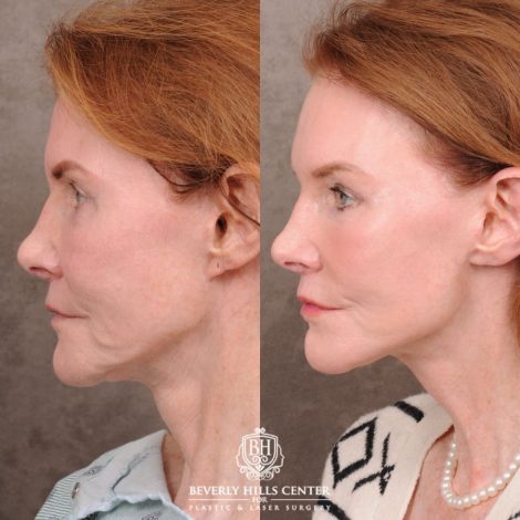 Beverly Hills Center Female Patient Before and After AuraLyft, Brow Lift, Nanofat with PRP