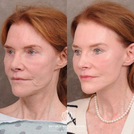 Beverly Hills Center Female Patient Before and After AuraLyft, Brow Lift, Nanofat with PRP