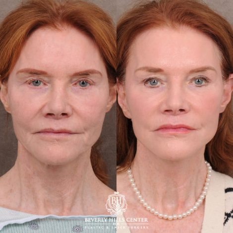 Beverly Hills Center Female Patient Before and After AuraLyft, Brow Lift, Nanofat with PRP