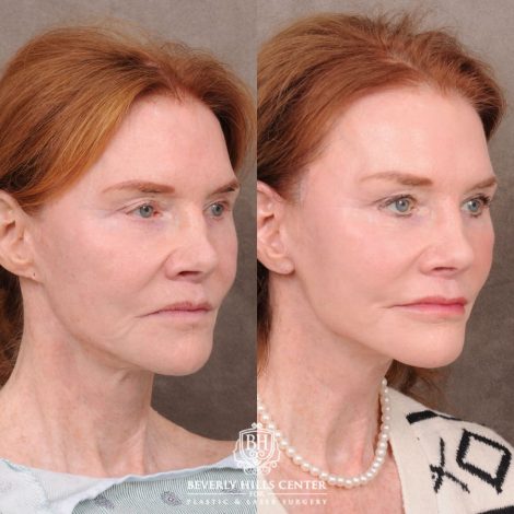 Beverly Hills Center Female Patient Before and After AuraLyft, Brow Lift, Nanofat with PRP