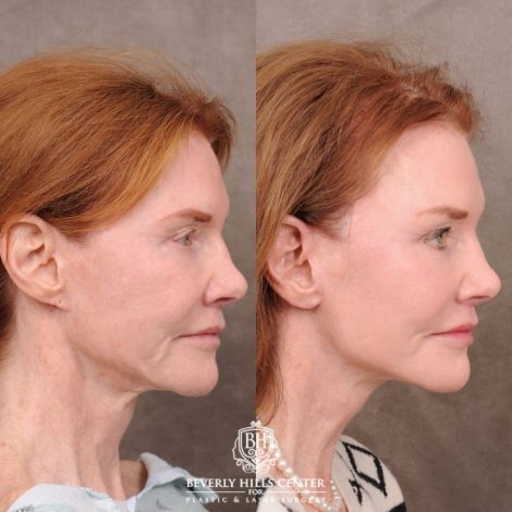 Beverly Hills Center Female Patient Before and After AuraLyft, Brow Lift, Nanofat with PRP