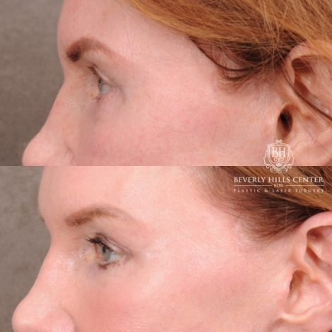 Beverly Hills Center Female Patient Before and After AuraLyft, Brow Lift, Nanofat with PRP