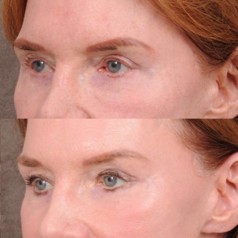 Beverly Hills Center Female Patient Before and After AuraLyft, Brow Lift, Nanofat with PRP