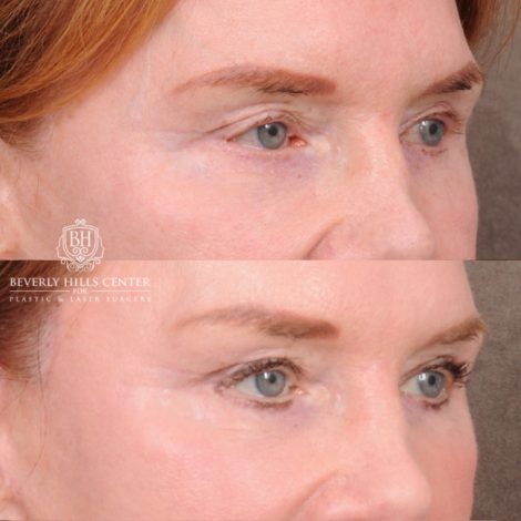Beverly Hills Center Female Patient Before and After AuraLyft, Brow Lift, Nanofat with PRP