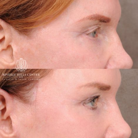 Beverly Hills Center Female Patient Before and After AuraLyft, Brow Lift, Nanofat with PRP