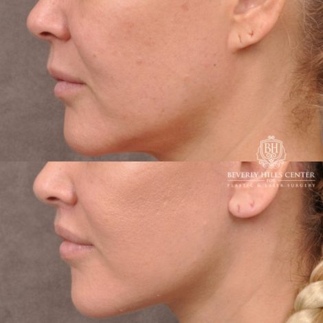 Beverly Hills Center Female Patient Before and After AuraLyft Porcedure