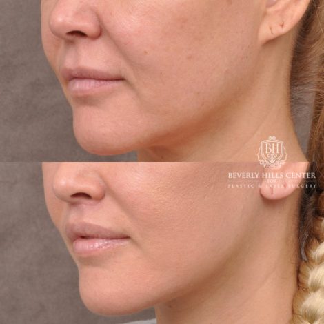 Beverly Hills Center Female Patient Before and After AuraLyft Porcedure
