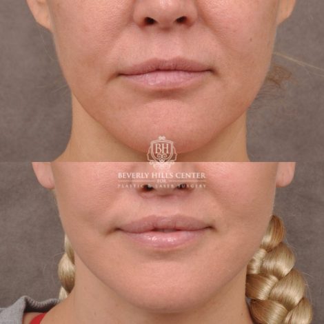 Beverly Hills Center Female Patient Before and After AuraLyft Porcedure