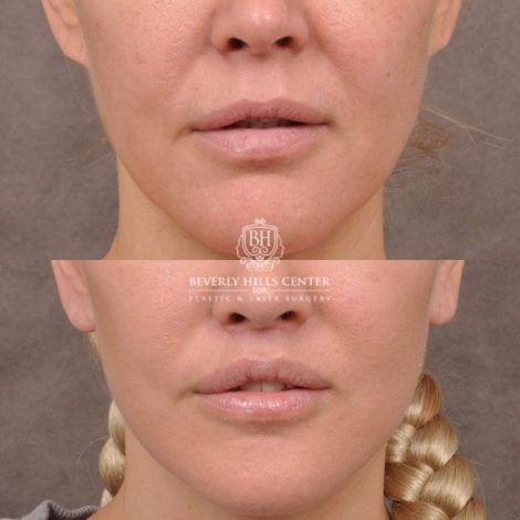 Beverly Hills Center Female Patient Before and After AuraLyft Porcedure