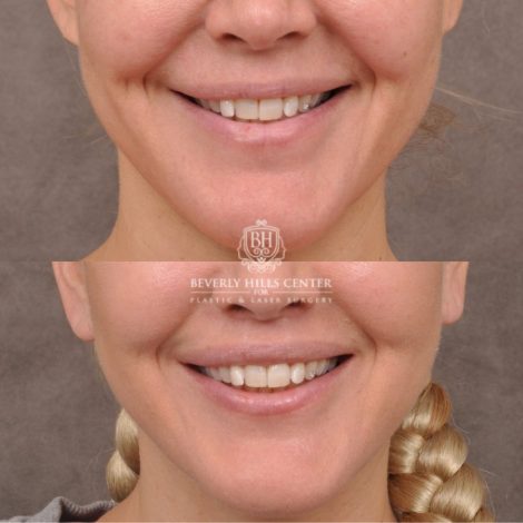 Beverly Hills Center Female Patient Before and After AuraLyft Porcedure