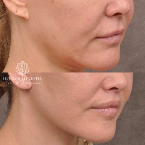 Beverly Hills Center Female Patient Before and After AuraLyft Porcedure