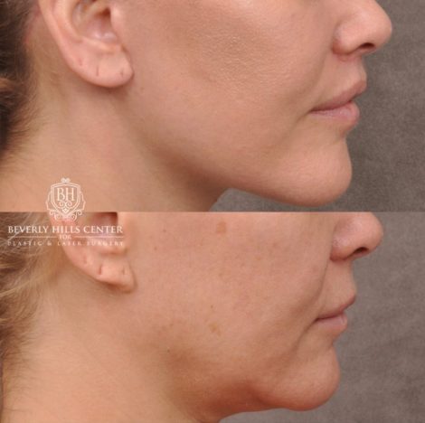 Beverly Hills Center Female Patient Before and After AuraLyft Porcedure