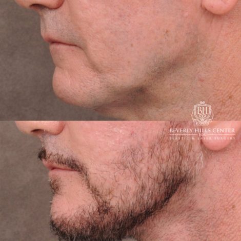 Beverly Hills Center Female Patient Before and After Comprehensive AuraLyft, Brow Lift, CUPID LIFT® Corner Lift