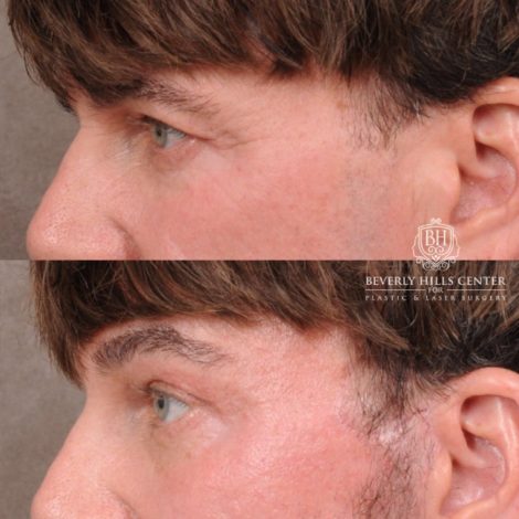 Beverly Hills Center Female Patient Before and After Comprehensive AuraLyft, Brow Lift, CUPID LIFT® Corner Lift