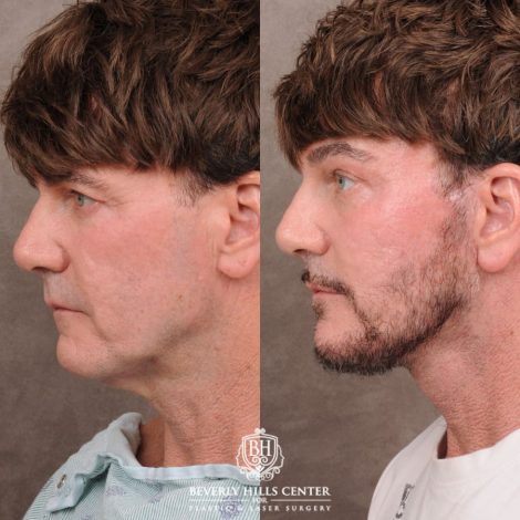 Beverly Hills Center Female Patient Before and After Comprehensive AuraLyft, Brow Lift, CUPID LIFT® Corner Lift