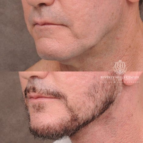 Beverly Hills Center Female Patient Before and After Comprehensive AuraLyft, Brow Lift, CUPID LIFT® Corner Lift