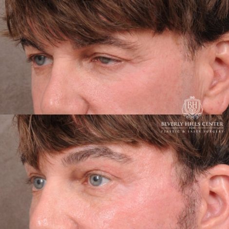 Beverly Hills Center Female Patient Before and After Comprehensive AuraLyft, Brow Lift, CUPID LIFT® Corner Lift