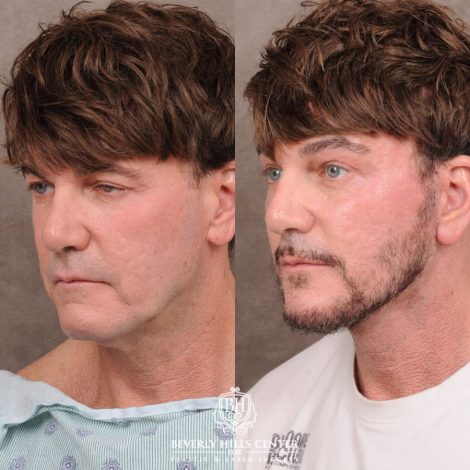 Beverly Hills Center Female Patient Before and After Comprehensive AuraLyft, Brow Lift, CUPID LIFT® Corner Lift