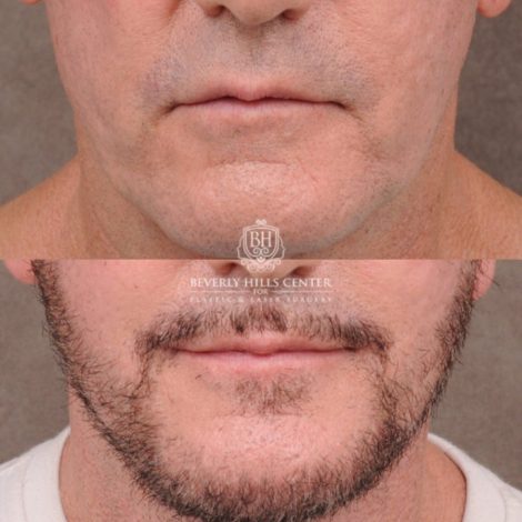 Beverly Hills Center Female Patient Before and After Comprehensive AuraLyft, Brow Lift, CUPID LIFT® Corner Lift