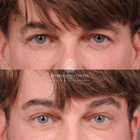 Beverly Hills Center Female Patient Before and After Comprehensive AuraLyft, Brow Lift, CUPID LIFT® Corner Lift