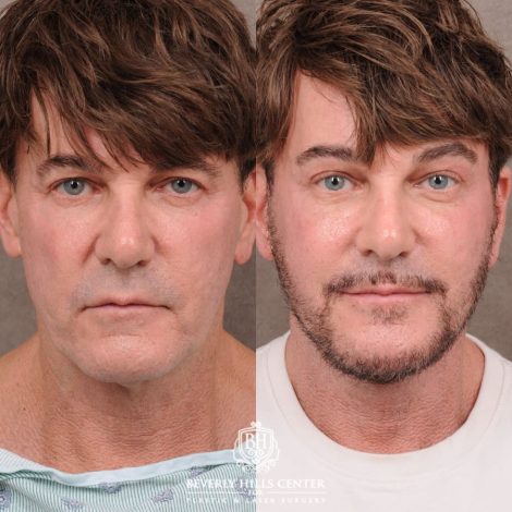 Beverly Hills Center Female Patient Before and After Comprehensive AuraLyft, Brow Lift, CUPID LIFT® Corner Lift