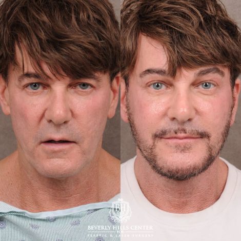 Beverly Hills Center Female Patient Before and After Comprehensive AuraLyft, Brow Lift, CUPID LIFT® Corner Lift