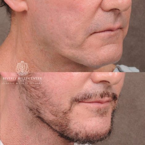 Beverly Hills Center Female Patient Before and After Comprehensive AuraLyft, Brow Lift, CUPID LIFT® Corner Lift