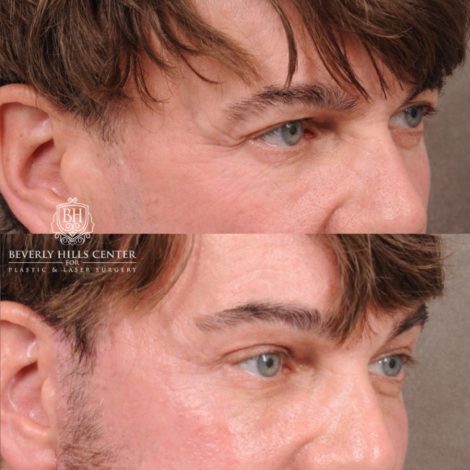 Beverly Hills Center Female Patient Before and After Comprehensive AuraLyft, Brow Lift, CUPID LIFT® Corner Lift