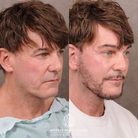 Beverly Hills Center Female Patient Before and After Comprehensive AuraLyft, Brow Lift, CUPID LIFT® Corner Lift