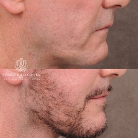 Beverly Hills Center Female Patient Before and After Comprehensive AuraLyft, Brow Lift, CUPID LIFT® Corner Lift