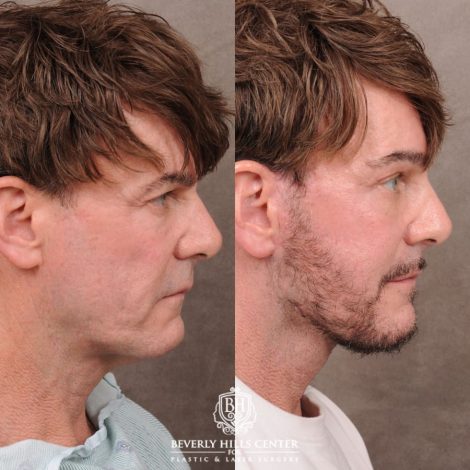 Beverly Hills Center Female Patient Before and After Comprehensive AuraLyft, Brow Lift, CUPID LIFT® Corner Lift