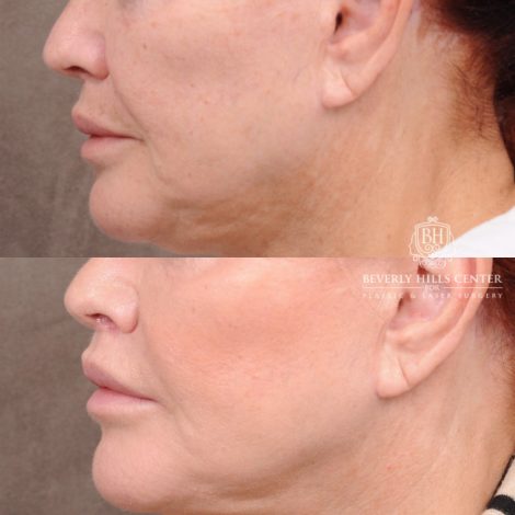Beverly Hills Center Female Patient Before and After CUPID LIFT® Lip Lift Procedure