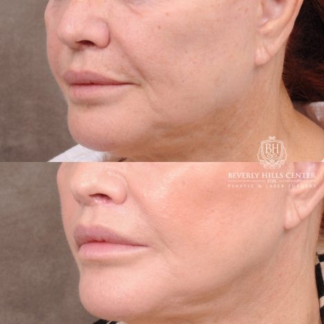Beverly Hills Center Female Patient Before and After CUPID LIFT® Lip Lift Procedure
