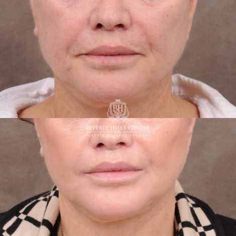 Beverly Hills Center Female Patient Before and After CUPID LIFT® Lip Lift Procedure