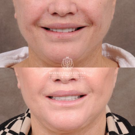 Beverly Hills Center Female Patient Before and After CUPID LIFT® Lip Lift Procedure
