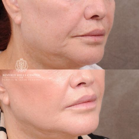 Beverly Hills Center Female Patient Before and After CUPID LIFT® Lip Lift Procedure