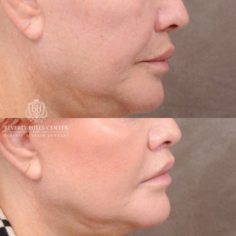 Beverly Hills Center Female Patient Before and After CUPID LIFT® Lip Lift Procedure