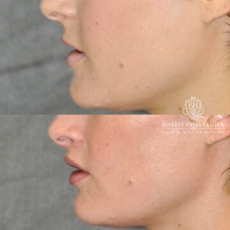 Beverly Hills Center Female Patient Before and After CUPID LIFT® Lip Lift Procedure